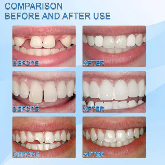 Tooth Repair Filling Material